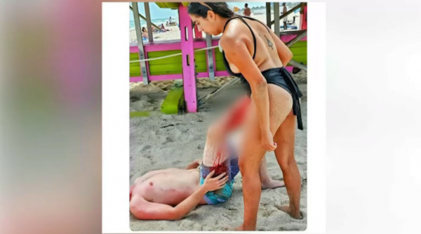 100720-Miami-Beach-shark-bite-victim.png
